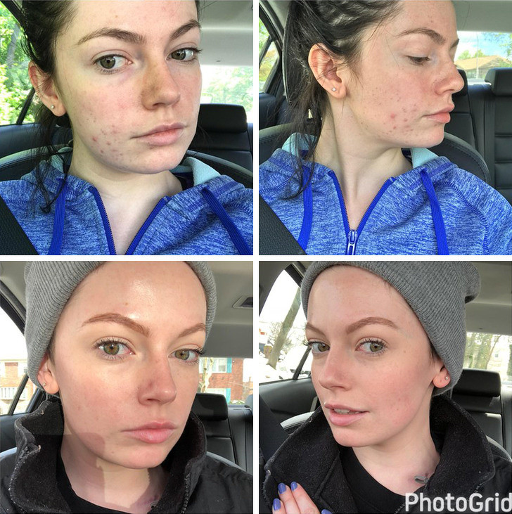 Reggel: hidratáló arclemosó, fényvédős arckrém - Este: micellás arclemosó, cink tartalmú arcszérum, hidratáló arckrém - Heti egyszer: AHA-savas peeling Reggel: hidratáló arclemosó, fényvédős arckrém - Este: micellás arclemosó, cink tartalmú arcszérum, hidratáló arckrém - Heti egyszer: AHA-savas peeling