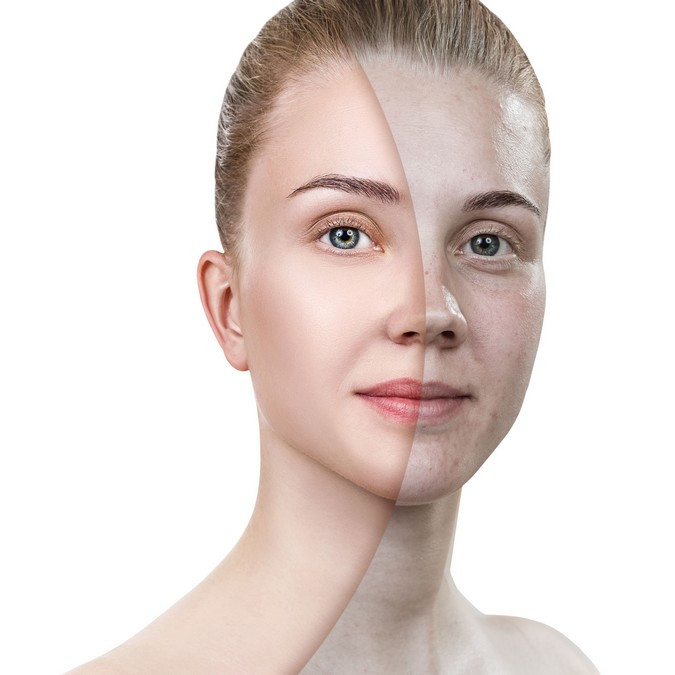 FAKÓ BŐR - Ez a probléma sokaknál fennáll, és általánosságban vérszegénységre utal. Abban az esetben, ha a sápadtság egy-egy arcrészen jelenik meg, feltétlenül konzultálj orvosoddal!