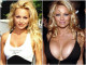 Pamela Anderson - A kebelcsoda korával egyenesen arányosan nőtt együtt a plasztikai sebészi beavatkozások száma. Mára már inkább elfordítjuk a fejünket, ha piros fürdőruhában elfutna a strandon. Pamela Anderson - A kebelcsoda korával egyenesen arányosan nőtt együtt a plasztikai sebészi beavatkozások száma. Mára már inkább elfordítjuk a fejünket, ha piros fürdőruhában elfutna a strandon.