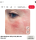 Vörös, gyulladt bőr

A bőr különböző gyulladásos problémái – például ekcéma, rosacea vagy piros, irritált foltok – gyakran a bélrendszer egyensúlyának zavarára vezethetők vissza. Ha a bélflóra sérül vagy a bél egészsége kompromittálódik, a gyulladás gyorsan megjelenhet a bőrön. Dr. Eliopoulos szerint ezek a tünetek gyakran a tejtermékek, a glutén vagy a cukor fogyasztása után jelentkeznek, különösen azoknál, akik antibiotikumos kezelésen estek át, puffadással vagy rendszertelen székletekkel küzdenek. A bélflóra helyreállítása probiotikumokkal, rostban gazdag étrenddel és a gyulladást kiváltó tényezők csökkentésével látványos javulást eredményezhet, és a bőr is gyorsan visszanyerheti egészséges, egyenletes tónusát.

 