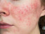 A rosacea egy nagyon gyakori bőrbetegség, amellyel nehéz felvenni a harcot, ám a kutatások szerint, ha naponta több csésze kávét fogyasztunk, azzal megelőzhetjük a kicsi, aknészerű dudorok kialakulását, melyek valójában apró erek a bőr felszíne alatt. Éppen ezért, ha felhagyunk a kávéfogyasztással, az azt is eredményezheti, hogy kialakul az erre hajlamosoknál ez a bőrbetegség, valamint a szem alatti sötét karikáktól is sokkal nehezebb lesz megszabadulnunk.
A rosacea egy nagyon gyakori bőrbetegség, amellyel nehéz felvenni a harcot, ám a kutatások szerint, ha naponta több csésze kávét fogyasztunk, azzal megelőzhetjük a kicsi, aknészerű dudorok kialakulását, melyek valójában apró erek a bőr felszíne alatt. Éppen ezért, ha felhagyunk a kávéfogyasztással, az azt is eredményezheti, hogy kialakul az erre hajlamosoknál ez a bőrbetegség, valamint a szem alatti sötét karikáktól is sokkal nehezebb lesz megszabadulnunk.