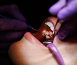 Szájsebészet: modern, fájdalommentes megoldások az Árkád Dentalnál