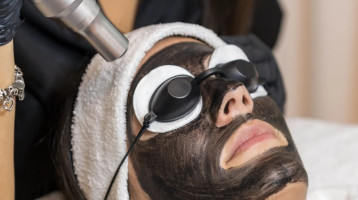 Carbon peeling: mikor érdemes választani, és mit várhatsz tőle?